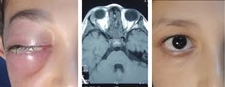 Orbital Selülit Belirtileri ve Tedavisi
