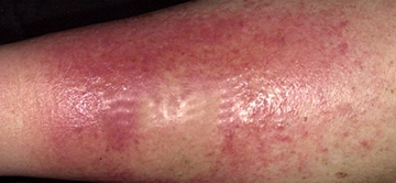 Selülit Hastalığı Belirtileri ve Tedavisi